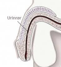Hvad er urinrørsbetændelse?